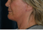 Natural Neck Lift