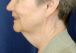 Natural Neck Lift