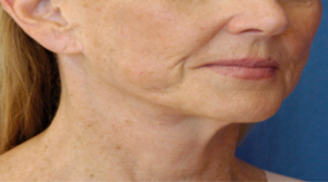 Natural Neck Lift