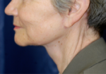 Natural Neck Lift