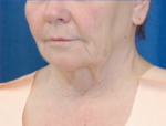 Natural Neck Lift