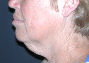 Natural Neck Lift