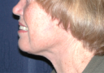 Natural Neck Lift