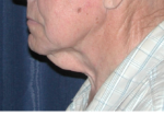 Natural Neck Lift