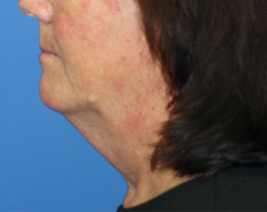 Natural Neck Lift