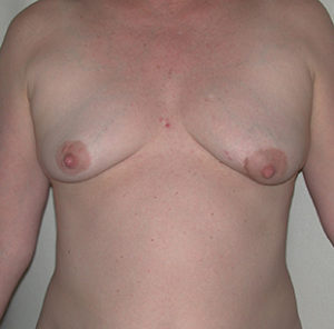 Breast Reconstruction