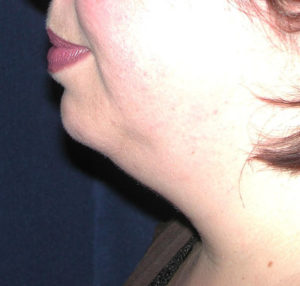 Submental Liposuction Case 5758 Before Photo Submental Liposuction