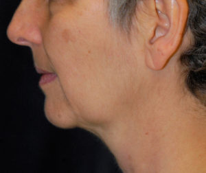 Natural Neck Lift