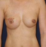 Breast Reconstruction