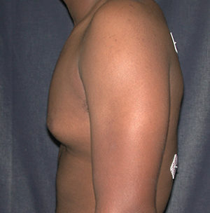 Gynecomastia Case 5839 Before Photo Gynecomastia