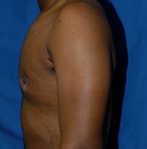 Gynecomastia Case 5839 After Photo Gynecomastia