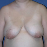 Breast Reconstruction