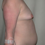 Breast Reconstruction