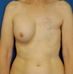 Breast Reconstruction