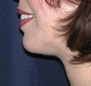 Submental Liposuction Case 5758 After Photo Submental Liposuction
