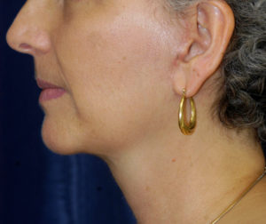 Natural Neck Lift