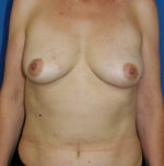 Breast Reconstruction