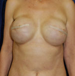 Breast Reconstruction