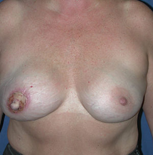 Breast Reconstruction Case 5818 After Photo Breast Reconstruction