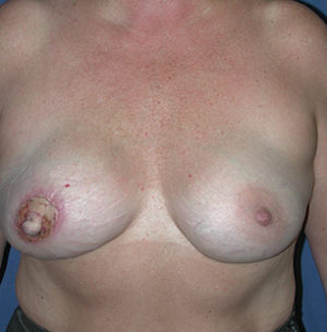 Breast Reconstruction