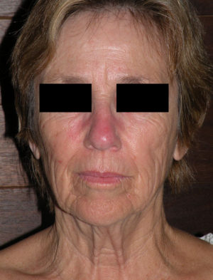 Facelift