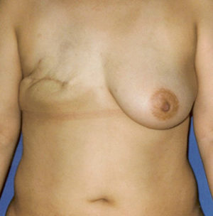 Breast Reconstruction