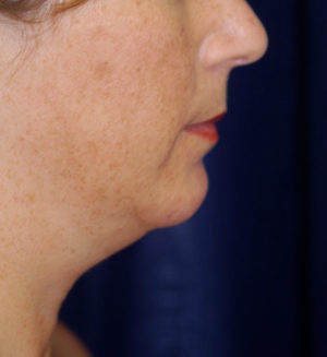 Submental Liposuction Case 5759 Before Photo Submental Liposuction