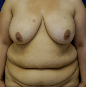 Breast Reconstruction