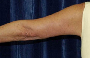 Brachioplasty Case 5774 After Photo Brachioplasty