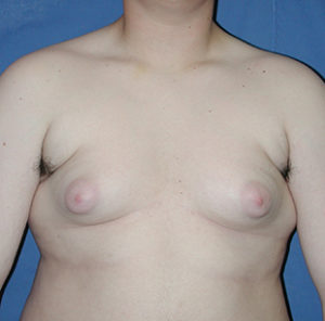 Gynecomastia