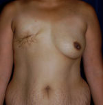 Breast Reconstruction