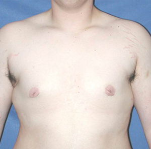 Gynecomastia