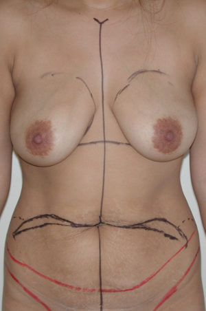 Abdominoplasty