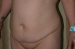 Abdominoplasty