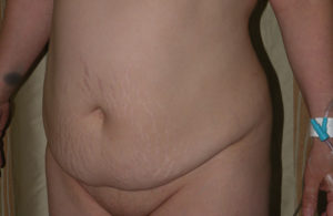 Abdominoplasty