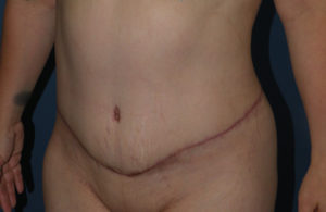 Abdominoplasty