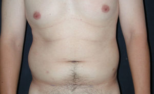 Liposuction