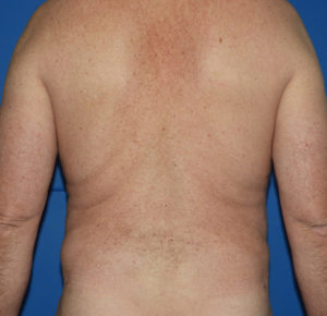 Liposuction Case 5896 After Photo Liposuction
