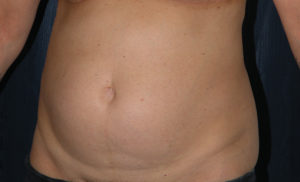 Liposuction