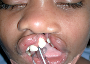 Cleft Palate / Cleft Lip