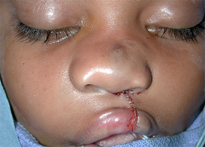 Cleft Palate / Cleft Lip