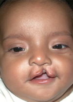 Cleft Palate / Cleft Lip