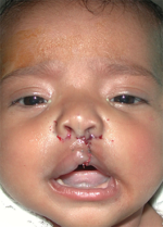 Cleft Palate / Cleft Lip