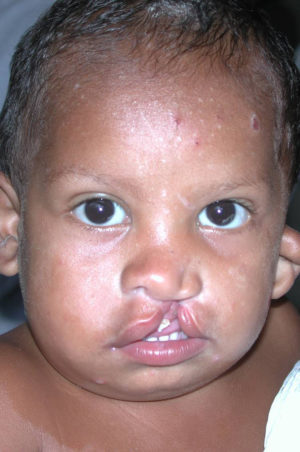 Cleft Palate / Cleft Lip