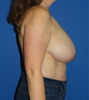 Breast Reduction