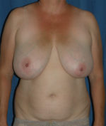 Breast Reduction