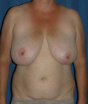 Breast Reduction