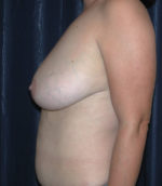 Breast Reduction