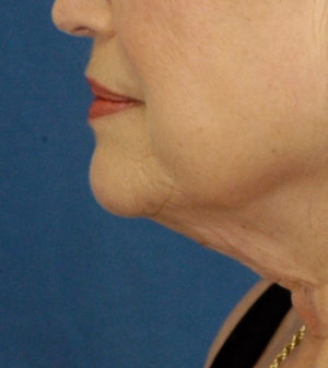 Natural Neck Lift