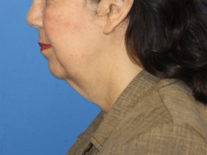 Natural Neck Lift Case 5980 Before Photo Natural Neck Lift